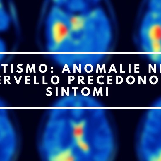 autismo anomalie cervello