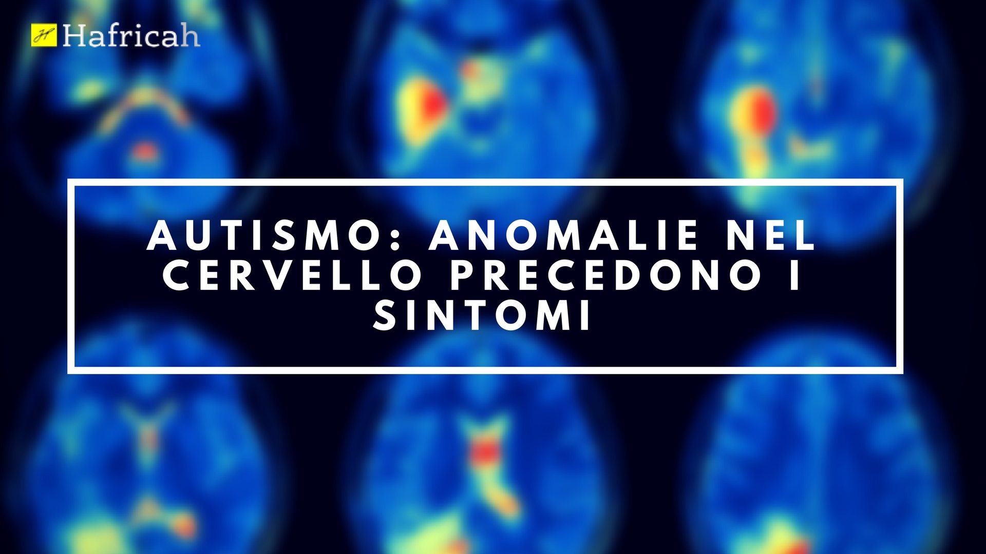 autismo anomalie cervello